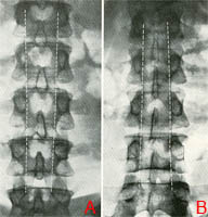 Fig. 58 – a) Acondroplasia - Rx lombare:diminuzione della distanza interpeduncolare da L1 a L5. Mentre normalmente (b) si allarga.